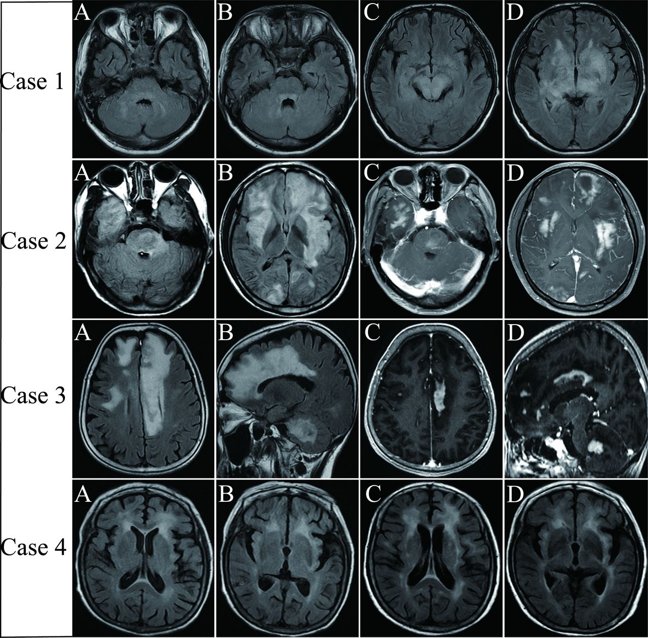Primary central nervous system T-cell lymphoma: a single-centre